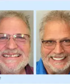 𝐇𝐢𝐝𝐨𝐧𝐞® – Advanced Customized Full Denture Set