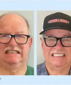 𝐇𝐢𝐝𝐨𝐧𝐞® – Advanced Customized Full Denture Set
