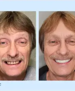 𝐇𝐢𝐝𝐨𝐧𝐞® – Advanced Customized Full Denture Set