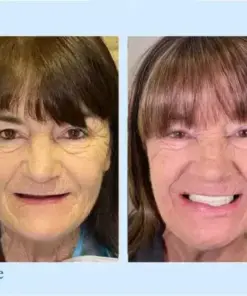 𝐇𝐢𝐝𝐨𝐧𝐞® – Advanced Customized Full Denture Set