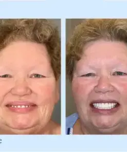 𝐇𝐢𝐝𝐨𝐧𝐞® – Advanced Customized Full Denture Set