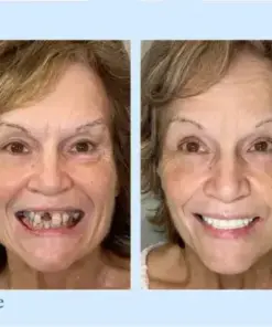 𝐇𝐢𝐝𝐨𝐧𝐞® – Advanced Customized Full Denture Set
