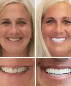 HZA™ – Advanced Customized Full Denture Set