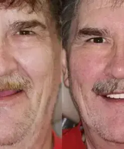 HZA™ Advanced Customized Full Denture Set