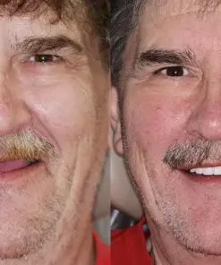 HZA™ Custom-Fit Functional Dentures