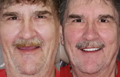 HZA™ Custom-Fit Functional Dentures