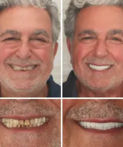 HZA™ Custom-Fit Functional Dentures