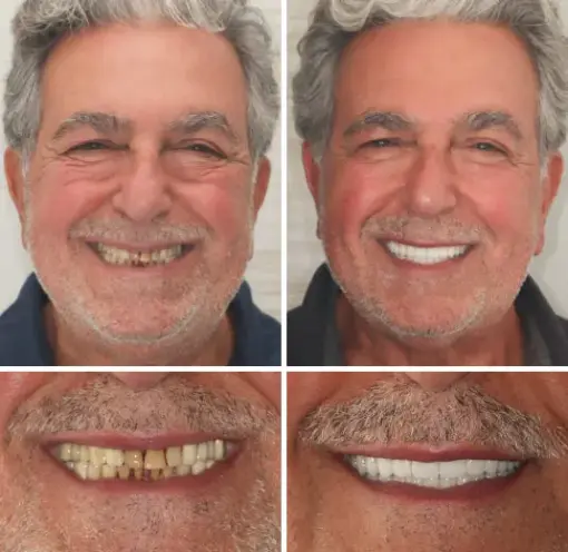 HZA™ Custom-Fit Functional Dentures